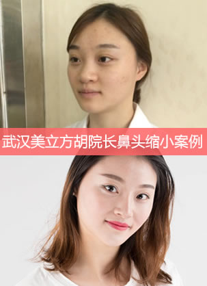 鼻头大怎么办 武汉美立方胡院长鼻头缩小案例摆脱大胖鼻子