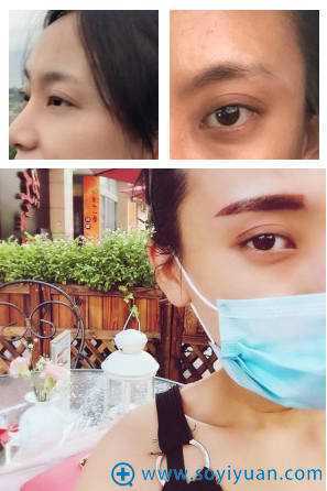上海古北悦丽医疗美容医院半纹眉案例 上海古北悦丽医疗美容医院半纹眉案例
