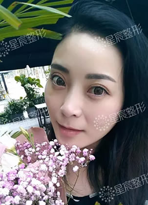《重庆星宸面部线雕提升整形记》30分钟让你重回少女脸