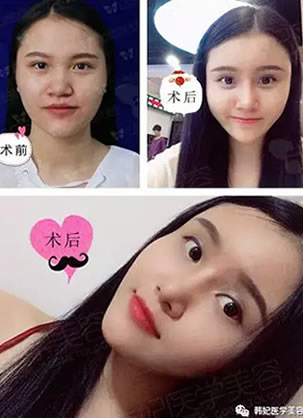 公开:广州韩妃景熙翔鼻综合整形+自体脂肪面部填充全过程