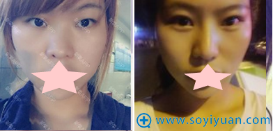 �Ͼ�ά���������ٻ�˫��Ƥ+¡������Ա�Ч��