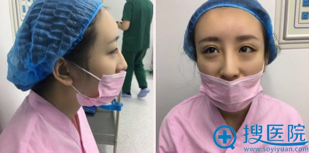 <!--<i data=20240710 data-id=11462></i>-->全切双眼皮手术前 <!--<i data=20240710 data-id=11462></i>-->全切双眼皮手术前