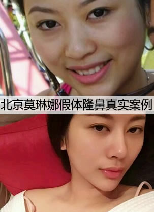真实求美经历告诉你北京莫琳娜医院邱凌燕隆鼻怎么样