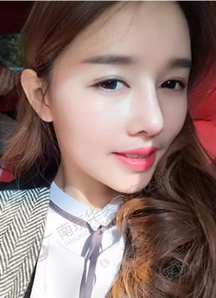 鼻综合手术和自体脂肪脸部填充案例解密南京华美整形如何