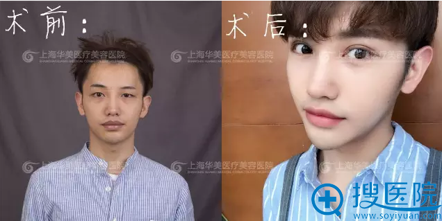 重睑双眼皮+光钎祛眼袋案例揭秘上海华美佀同帅医生怎么样