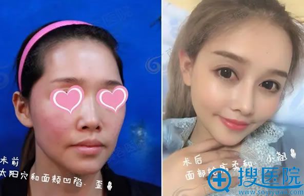 在南京华美整形前后对比照 在南京华美整形前后对比照
