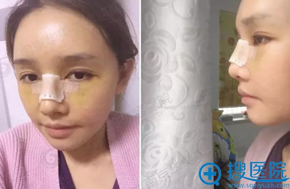 南京华美整形自体脂肪填充全脸术后照 南京华美整形自体脂肪填充全脸术后照