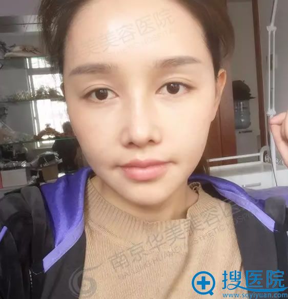 鼻部整形术后2周照片 鼻部整形术后2周照片