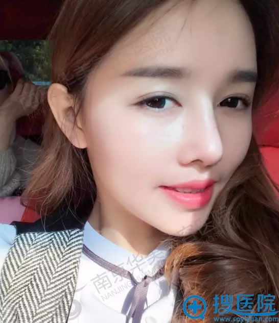 自体脂肪填充全面部术后第3周效果图 自体脂肪填充全面部术后第3周效果图