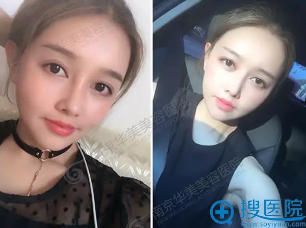 南京华美鼻综合和脂肪填充案例图 南京华美鼻综合和脂肪填充案例图