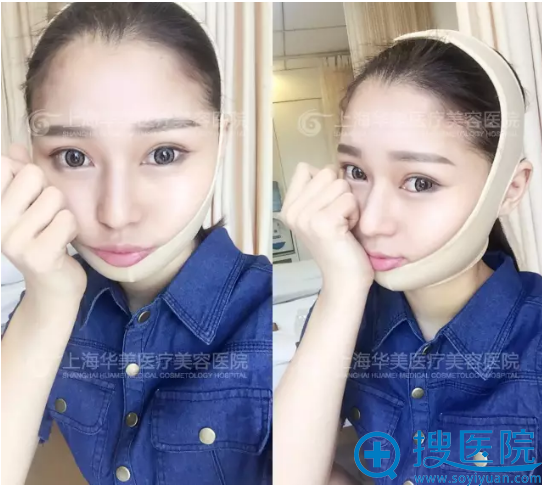 下颌角整形术后7天恢复效果 下颌角整形术后7天恢复效果