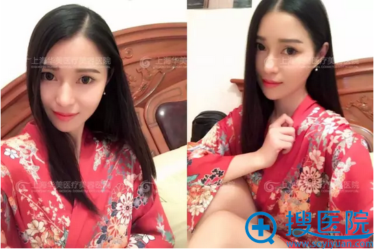 做下颌角两个月生活照 做下颌角两个月生活照