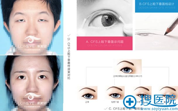 北京CFS上睑下垂矫正术 北京CFS上睑下垂矫正术