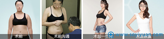 <!--<i data=20240710 data-id=12037></i>-->整形李小正吸脂案例 <!--<i data=20240710 data-id=12037></i>-->整形李小正吸脂案例