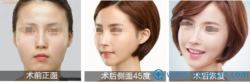 <!--<i data=20240710 data-id=12037></i>-->整形余成坤隆鼻+面部精雕案例 <!--<i data=20240710 data-id=12037></i>-->整形余成坤隆鼻+面部精雕案例