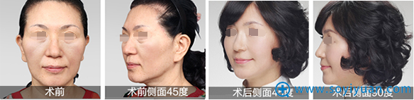 <!--<i data=20240710 data-id=12037></i>-->整形郭敬松除皱案例 <!--<i data=20240710 data-id=12037></i>-->整形郭敬松除皱案例