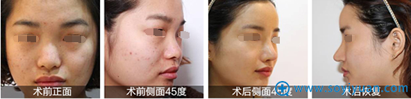 <!--<i data=20240710 data-id=12037></i>-->整形吕鹏涛祛斑案例 <!--<i data=20240710 data-id=12037></i>-->整形吕鹏涛祛斑案例