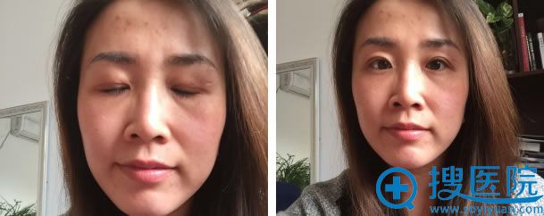 上睑下垂恢复2周的效果 上睑下垂恢复2周的效果