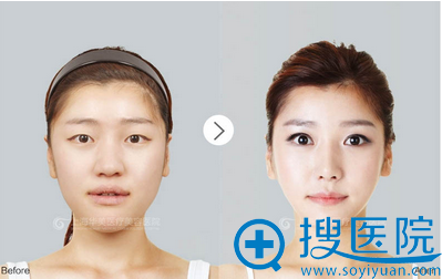 上海华美<!--<i data=20240710 data-id=16294></i>-->双眼皮案例 上海华美<!--<i data=20240710 data-id=16294></i>-->双眼皮案例