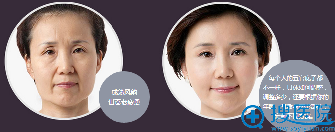 上海华美聂婕面部年轻化案例 上海华美聂婕面部年轻化案例