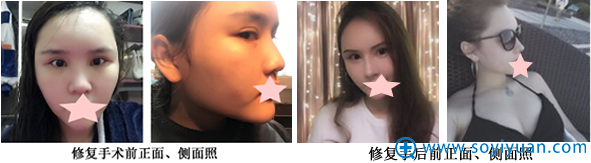 大连科美杨明洁做鼻子好吗?半肋骨隆鼻修复手术案例为你揭秘