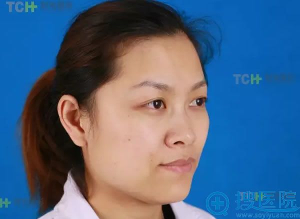 在重庆时光整形医院做鼻子术前照 在重庆时光整形医院做鼻子术前照
