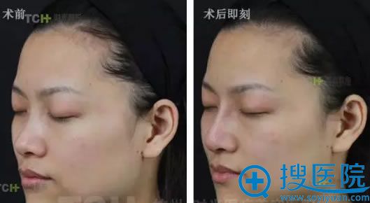 玻尿酸隆鼻术后即刻效果对比照 玻尿酸隆鼻术后即刻效果对比照