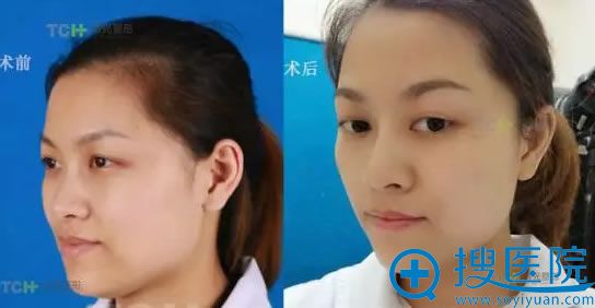 玻尿酸注射隆鼻术后第2天前后对比照 玻尿酸注射隆鼻术后第2天前后对比照