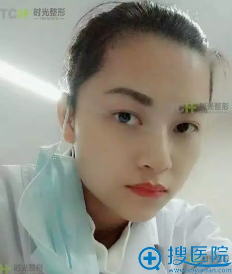 重庆时光整形玻尿酸隆鼻案例图 重庆时光整形玻尿酸隆鼻案例图