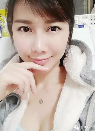 自体脂肪面部填充术后效果见证重庆铂生杜亚旭整形好不好?