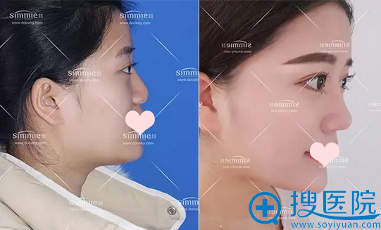 在上海喜美做完鼻综合+自体脂肪填充+面部提升 气质变化好惊人
