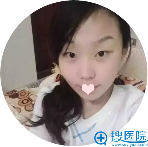 鼻综合+割双眼皮案例揭秘绍兴维美整形医院韩兴斌技术怎么样