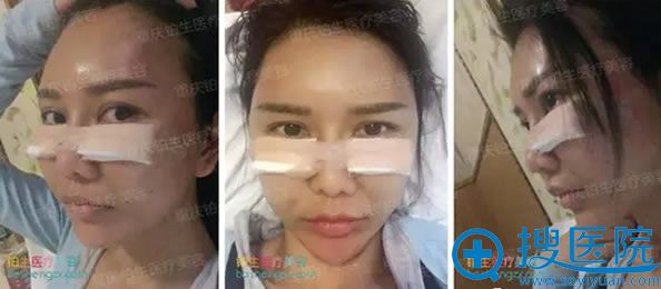 杜亚旭院长自体脂肪填充面部术后即刻效果 杜亚旭院长自体脂肪填充面部术后即刻效果