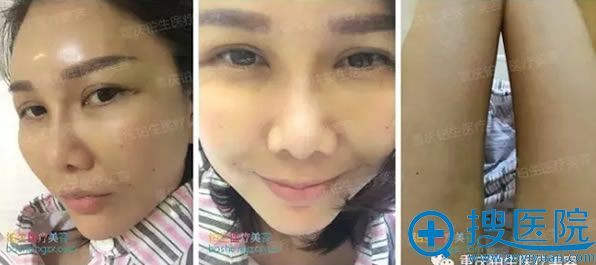 全面部自体脂肪填充术后第3天恢复效果 全面部自体脂肪填充术后第3天恢复效果