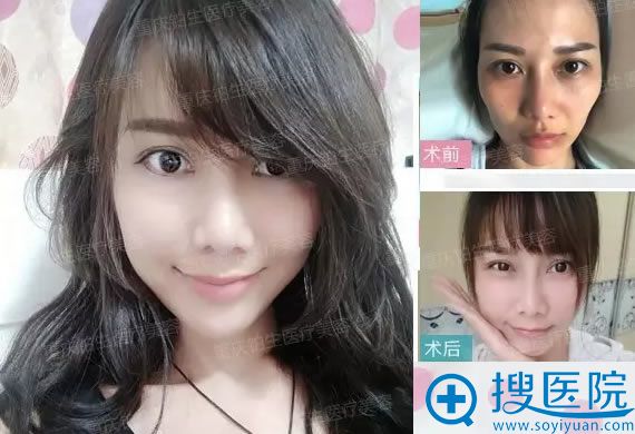 <!--<i data=20240710 data-id=12390></i>-->杜亚旭脂肪填充前后对比照 <!--<i data=20240710 data-id=12390></i>-->杜亚旭脂肪填充前后对比照