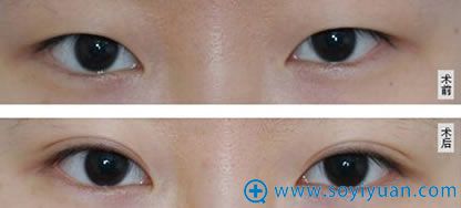 广州华美王向阳双眼皮案例图 广州华美王向阳双眼皮案例图