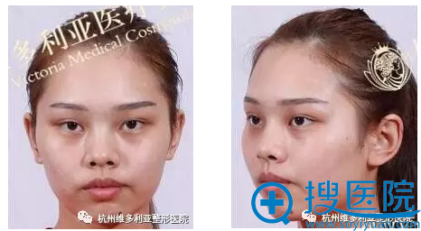 变美要趁早,我陪闺蜜找杭州维多利亚刘中策院长做了鼻综合隆鼻