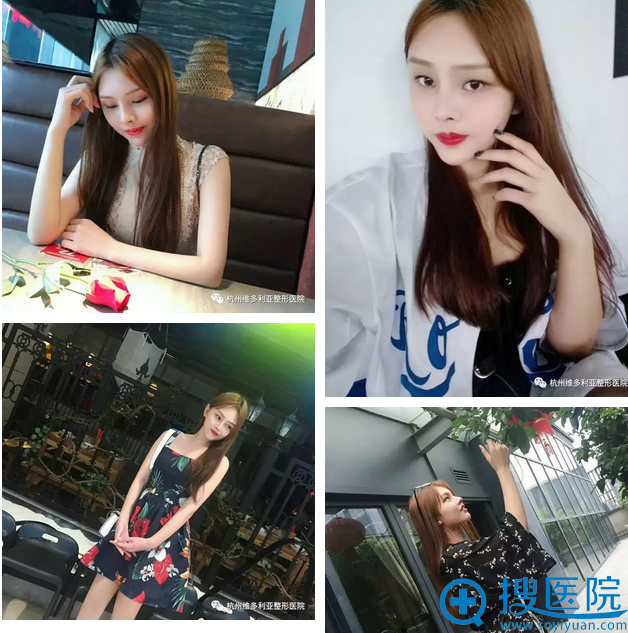 隆鼻+隆下巴+面雕术后生活照 隆鼻+隆下巴+面雕术后生活照