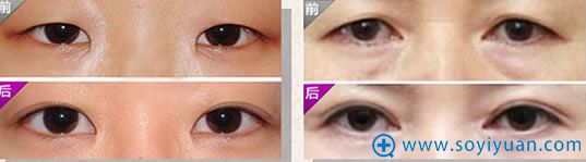 重庆华美整形双眼皮案例图 重庆华美整形双眼皮案例图