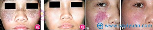 重庆华美激光祛斑和祛痣案例照片 重庆华美激光祛斑和祛痣案例照片
