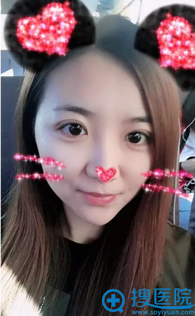 双眼皮术后7天,好自然 双眼皮术后7天,好自然