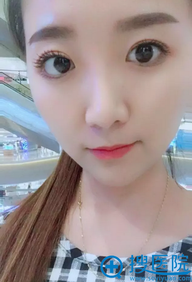 双眼皮一个月效果 双眼皮一个月效果