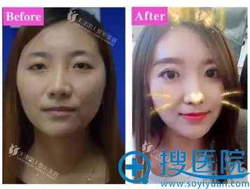 双眼皮前后对比照 双眼皮前后对比照
