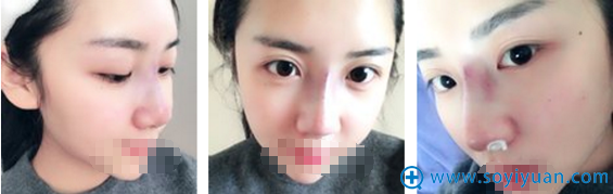 陈富全硅胶鼻综合术后1天恢复效果 陈富全硅胶鼻综合术后1天恢复效果