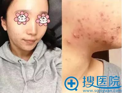 在新疆华美整形医院祛痘术前照片 在新疆华美整形医院祛痘术前照片