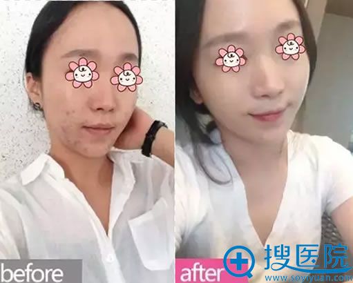 新疆华美祛痘前后对比案例效果图 新疆华美祛痘前后对比案例效果图