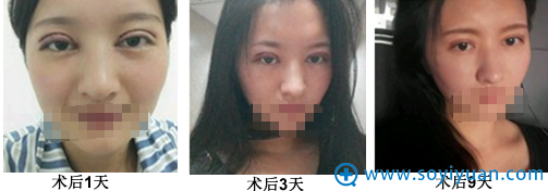 ���ں���ҽԺѦ������˫��Ƥ����ǰ�ָ�Ч��