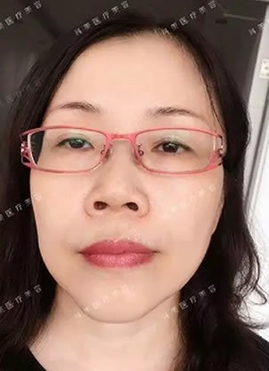 在珠海科美做自体生长因子+脂肪填充鼻唇沟后 让我减龄10岁