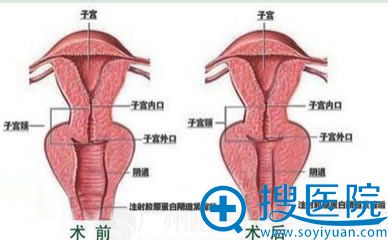 中家医家庭医生阴道紧缩前后对比图 中家医家庭医生阴道紧缩前后对比图