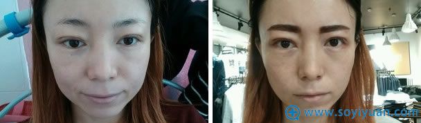 双眼皮失败修复第7天 双眼皮失败修复第7天